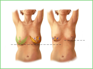  Операция по уменьшению груди
