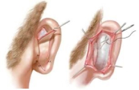 Коррекция ушей