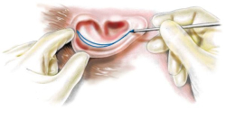 Отопластика при лопоухости