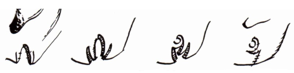 Пластика мочки  после повреждений уха