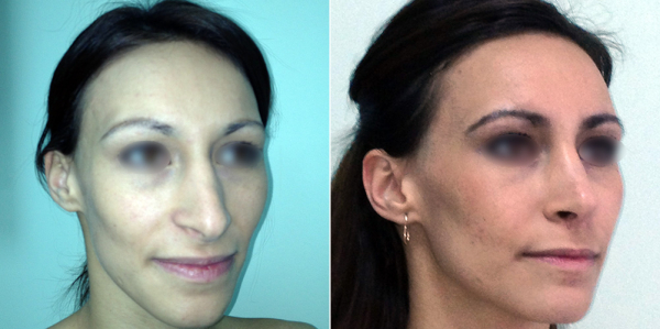 Фото пациентки Кристины до и после ринопластики у Светланы Пшонкиной