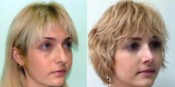 Фото пациентки до и после ринопластики у Светланы Пшонкиной