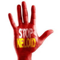 Келоидные рубцы. Как с ними бороться?