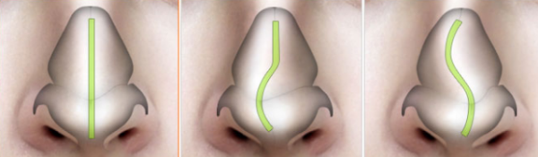 Искривление носовой перегородки