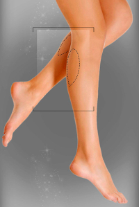 Имплантация голеней у доктора Али Алиева