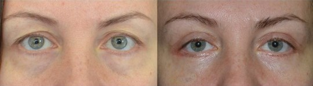 Фото до и после блефаропластики у Давида Гришкяна