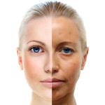 Мини-поддтяжка лица Face life