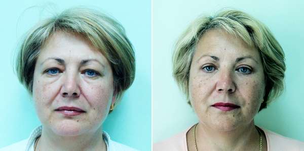 Визаж Лифт до и после