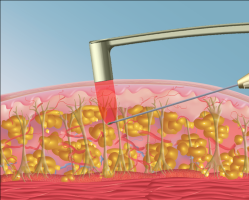 Малоинвазивный радиочастотный лифтинг FaceTite