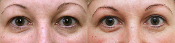 Фото до и после лазерной блефаропластики у Александра Жукова