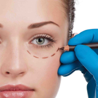 Блефаропластика