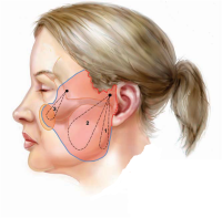 Виды подтяжек лица