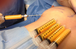 Липофилинг груди