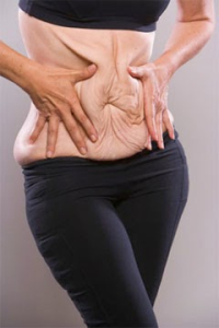 Панникулэктомия избавит от избытков кожи