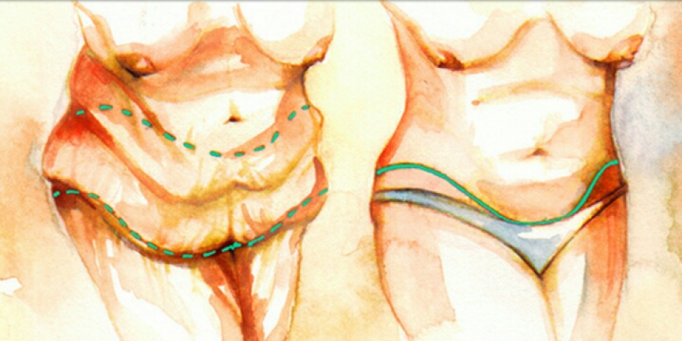 Удаление избытков кожи на животе