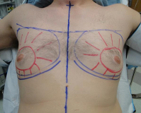 Разметка при гинекомастии