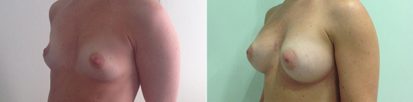 Увеличение груди Ideal Breast