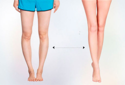 Как избавиться от кривизны ног?