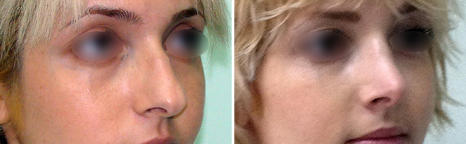До и после удаления горбинки носа