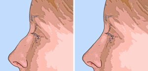 Убрать горбинку на носу ринопластика