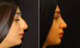 Геворг Степанян. Пациентка до и после ринопластики