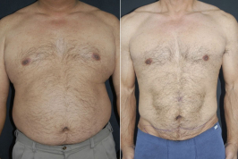 Липосакция живота мужчины