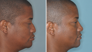 Афроамериканский нос ринопластика Геворг Степанян