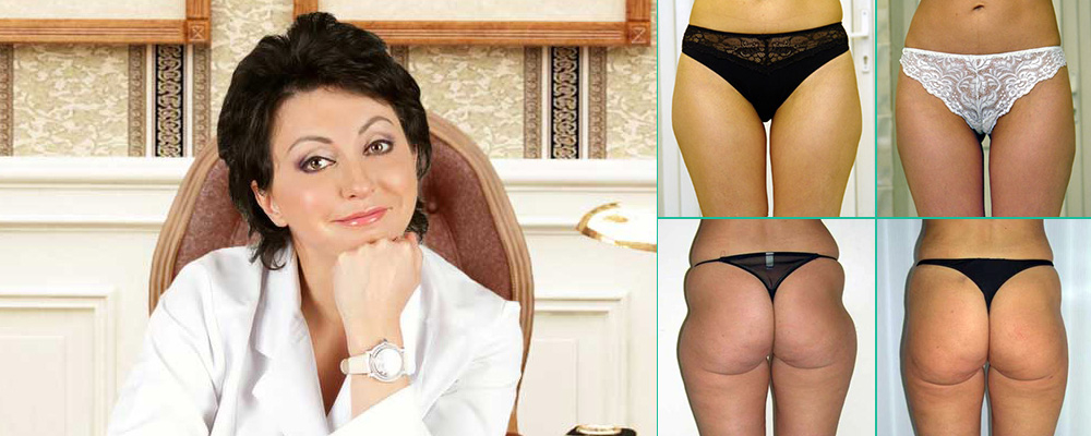 Иванченкова лучший хирург по липосакции