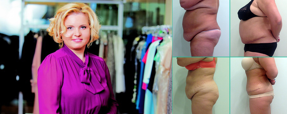 Пшонкина лучший хирург по абдоминопластике