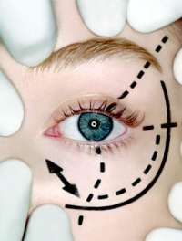 Всё о трансконъюнктивальной блефаропластике