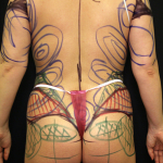 VASER-липофилинг ягодиц: соблазнительные формы за 1 час