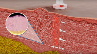 Воздействие лазерного аппарата UltraPulse CO2