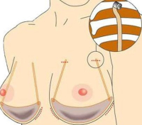 Внутренний бюстгальтер Orbix Medical