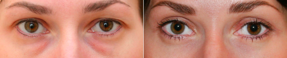 До и после блефаропластики. Александр Жуков