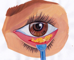 Нижняя блефаропластика без разрезов