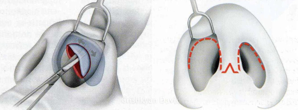 Пациенты интересуются, что же все-таки лучше: открытая или зарытая ринопластика?