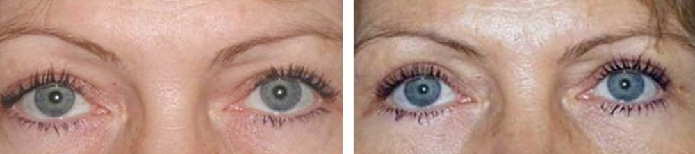 Круговая блефаропластика у Алексея Гварамии