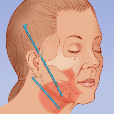 Подтяжка лица эндотинами