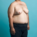 Гинекомастия