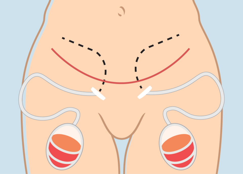 Дренажи после абдоминопластики