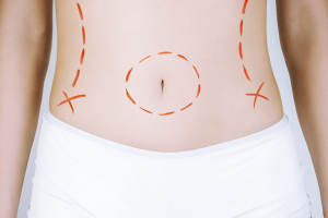 Умбиликальный доступ