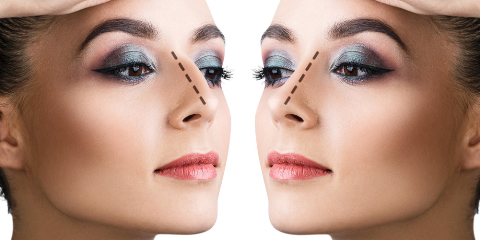 Ринопластика