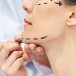 Нитевой лифтинг: за и против