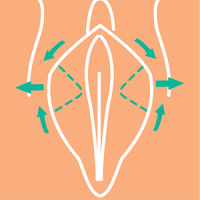 Лабиопластика