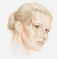 Височный лифтинг