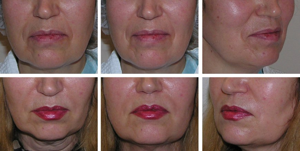 Что еще нужно знать о липофилинге лица? Какие преимущества и недостатки характеризуют этот способ омоложения?