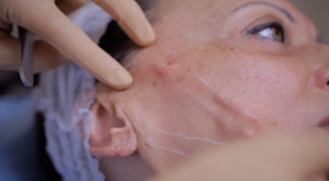 Какими бывают осложнения после тредлифтинга?