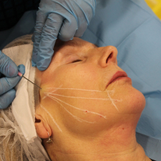 Омоложение мезонитями: какими бывают осложнения после тредлифтинга?