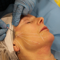 Омоложение мезонитями: какими бывают осложнения после тредлифтинга?