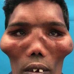 В Индии прооперировали человека с 